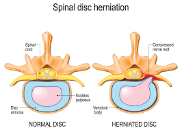 Herniated Disc